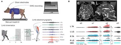 MR Tractography-Based Targeting and Physiological Identification of the Cuneiform Nucleus for Directional DBS in a Parkinson’s Disease Patient With Levodopa-Resistant Freezing of Gait